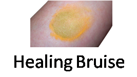 Healing Bruise